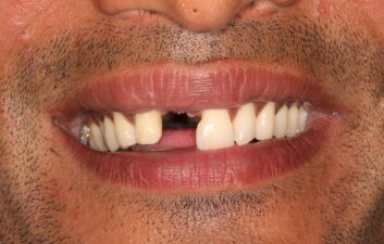 Front tooth implant before