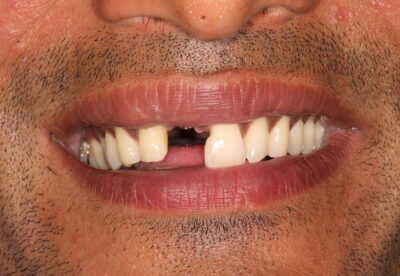 Front tooth implant before