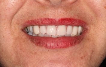 dental_implants_london_after