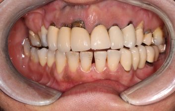 dental_implants_london_before