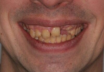 Dentist Implant London