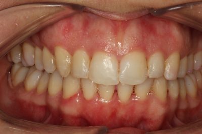 Invisalign Treatment after