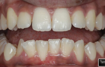 Invisalign best north london dentist before