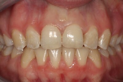 smile_cliniq_lingual_braces_retracted_after