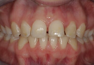 smile_cliniq_lingual_braces_retracted_before