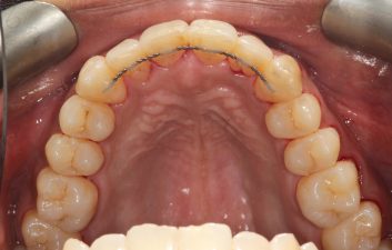 Lingual-braces-london-after