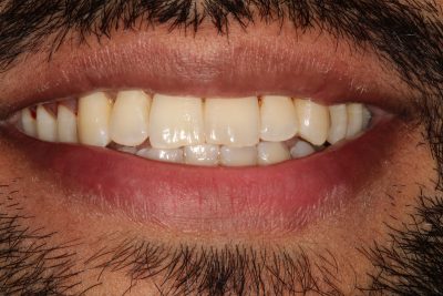 lingual_braces_london_after