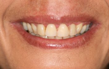 dental_implants_london_after