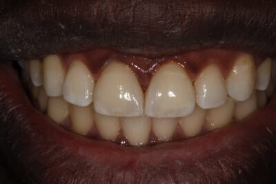 cosmetic_dentist_london_after