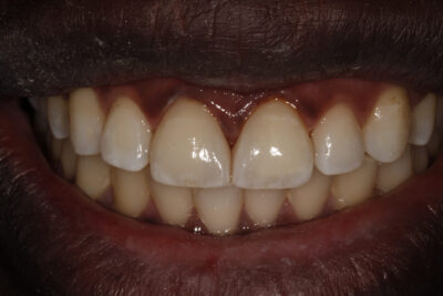 diastema_spacing_treatment_after