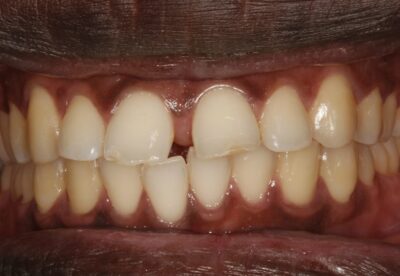 diastema_spacing_treatment_before