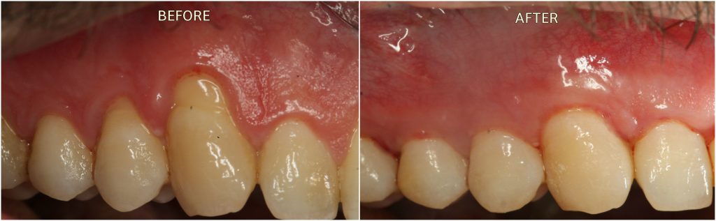 Receding Gums in London Treatment Before and After