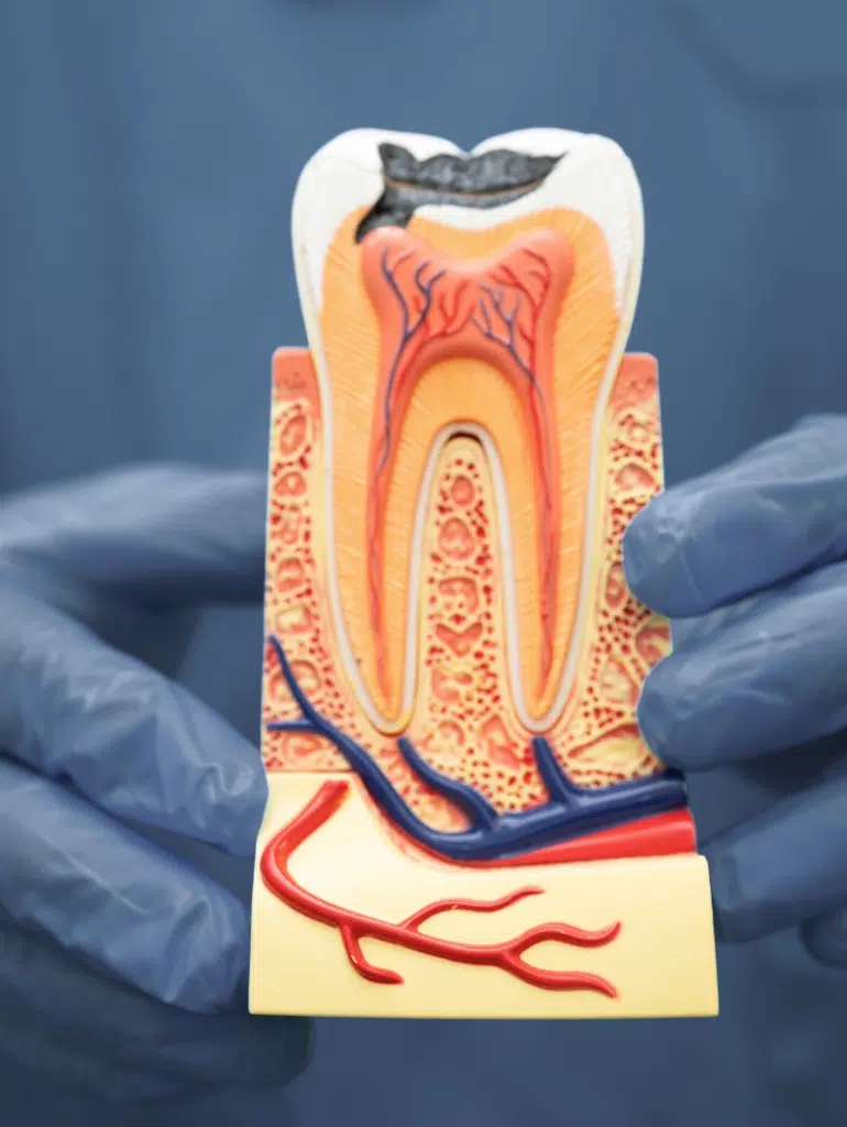 root canal treatment london