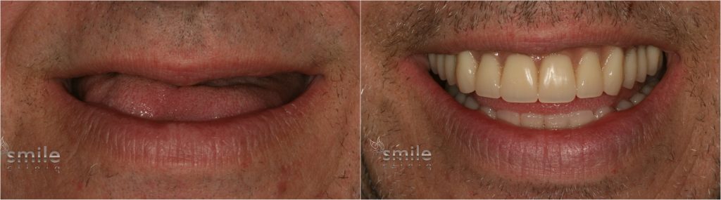 Zygomatic Implants Dentist London