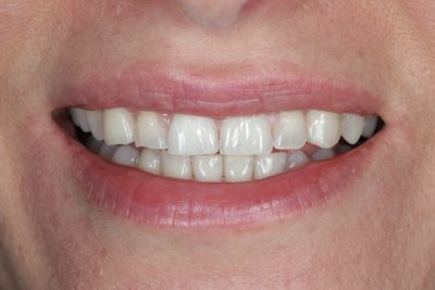 Teeth Spacing After