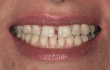 Teeth_Spacing_London_before