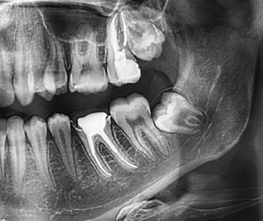 wisdom teeth removal