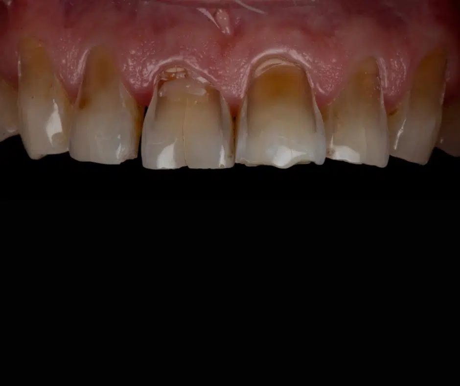 acid erosion beforee