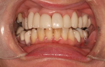 dental-crowns-london-after