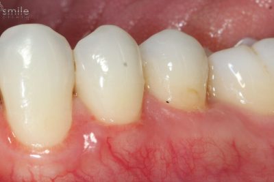 receding gum treatment after