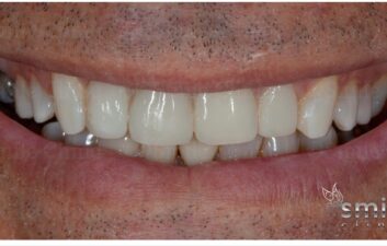 After composite veneers London