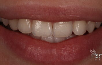 after grey tooth whitening london dentist