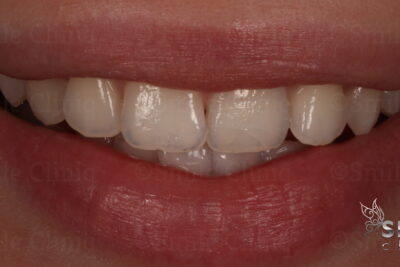 internal tooth whitening finchley dentist after