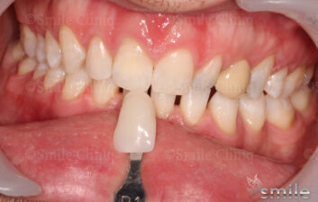 grey front tooth whitening after 