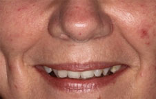 Invisalign in London after