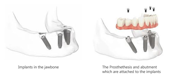 All-On-4 Dental Implants