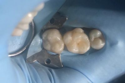 amalgam_removal_london_after