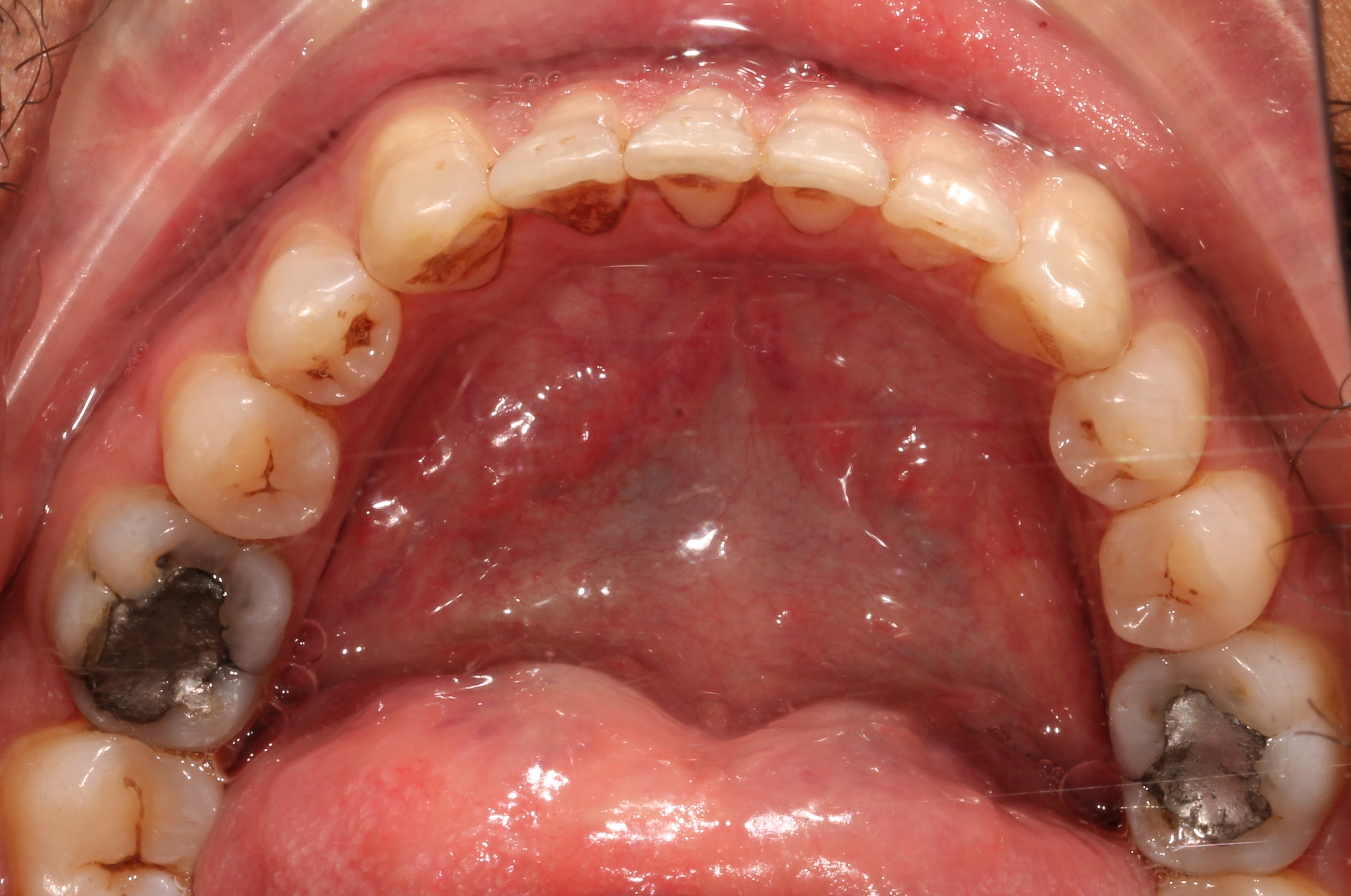 Smile Cliniq Mercury Filling Removal, Amalgam Removal London