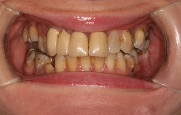 dental-crowns-london-before