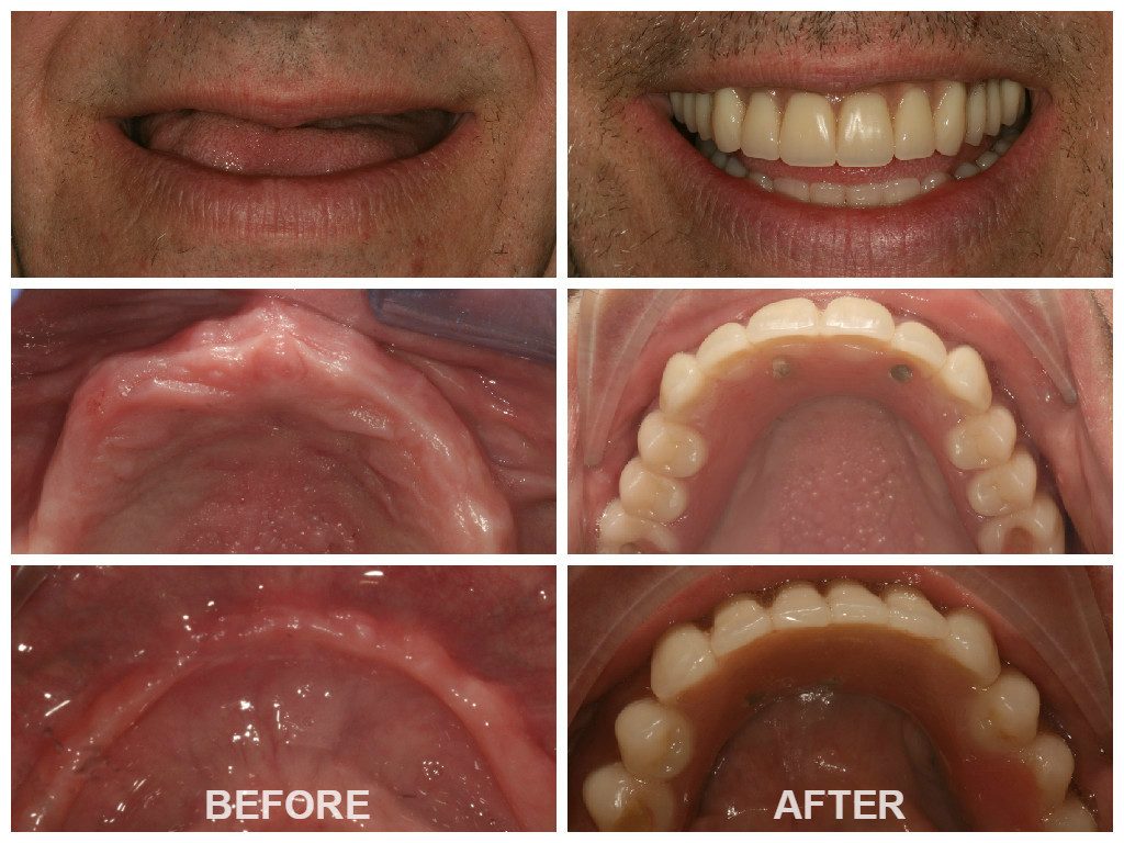 Before and After Zygomatic Arch Implants London