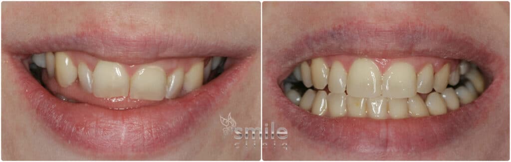Before And After Dental Treatment before and after dental treatment