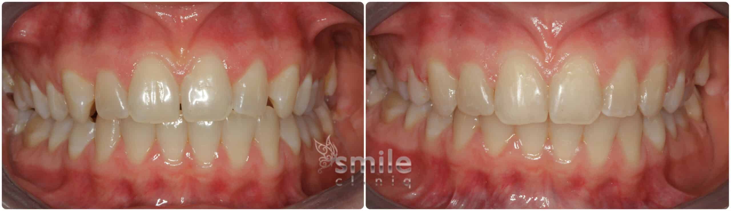 Before And After Dental Treatment Comparison before and after dental treatment comparison