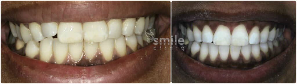 Before And After Dental Treatment before and after dental treatment