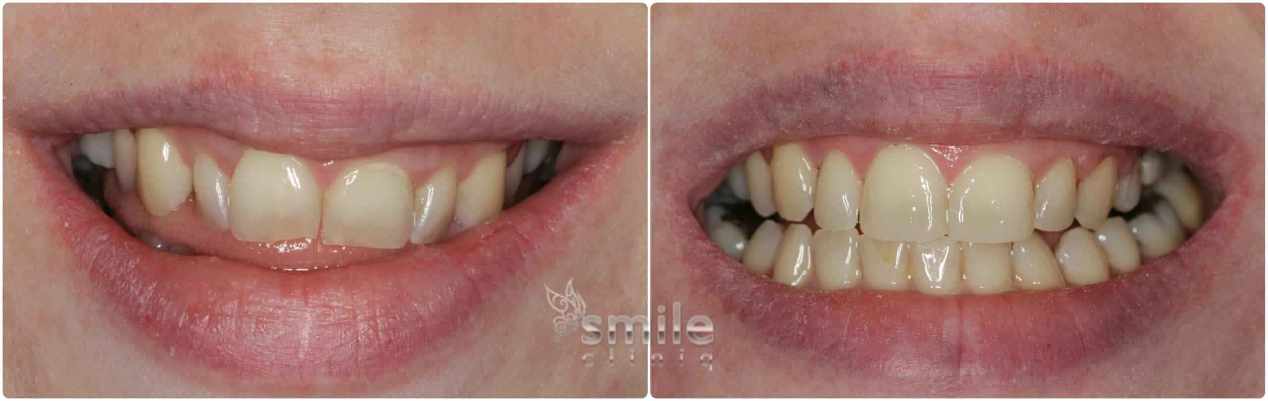 Before And After Dental Treatment before and after dental treatment