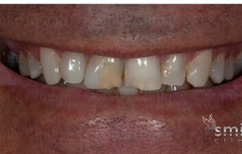 Before composite veneers london dentist