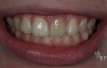 before grey tooth whitening london dentist