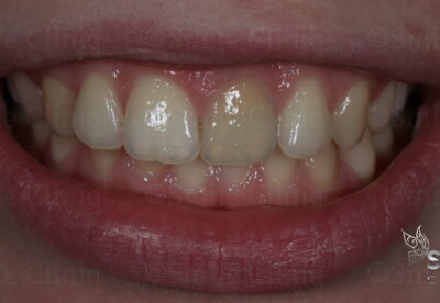 internal tooth whitening finchley dentist before