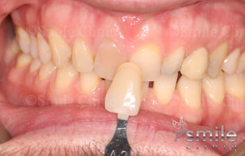 grey front tooth whitening before