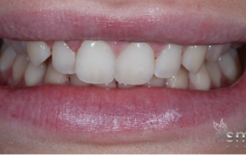 before invisalign london dentist