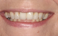 Invisalign in London before