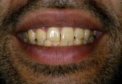 Tooth Whitening in London Before