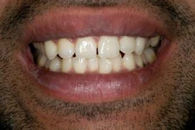 Tooth Whitening in London After
