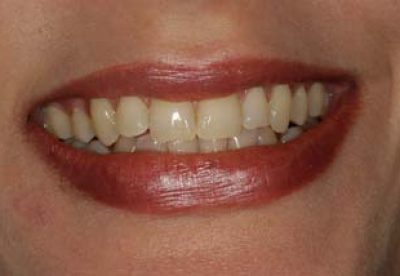 Teeth whitening dentist london before