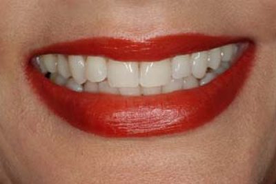 Teeth whitening dentist london after