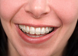 Ceramic brackets 
