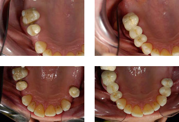 Dental Bridge Before and After